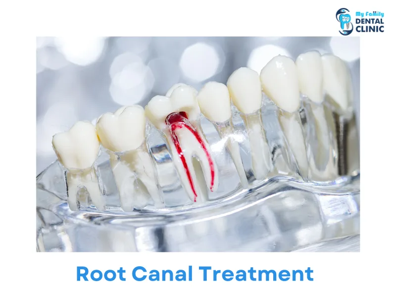 Root canal treatment