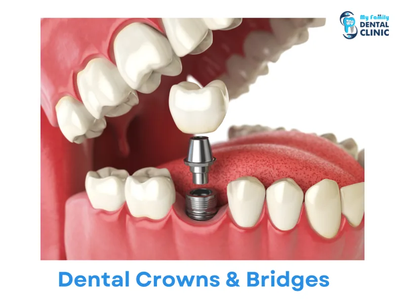 Dental Crowns & Bridges